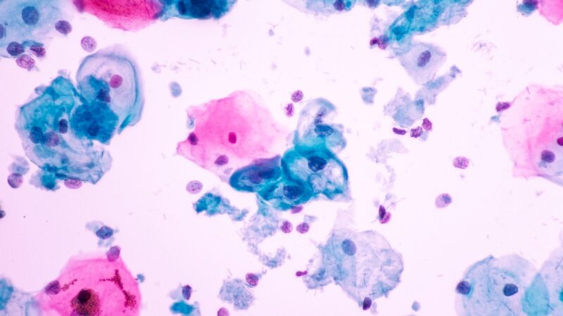 Cervical Cancer