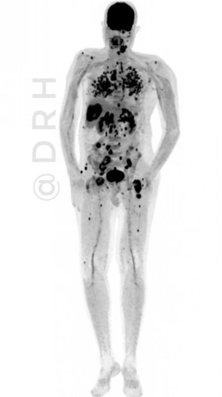 Harish Nagaraj: Case Highlight - Metastatic Carcinoma of Unknown Primary