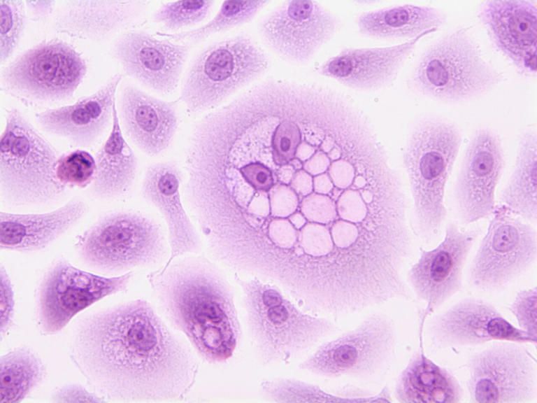 Hung Trinh: Cancer-Fighting Herpes Virus Shown to Be Effective for Some Advanced Melanoma
