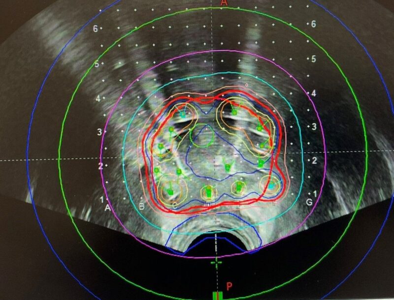 Highlights From Brachytherapy Awareness Day by Hathal Haddad