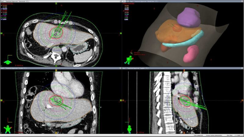 Highlights From Brachytherapy Awareness Day by Hathal Haddad