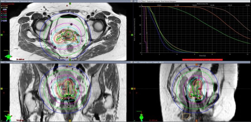 Highlights From Brachytherapy Awareness Day by Hathal Haddad