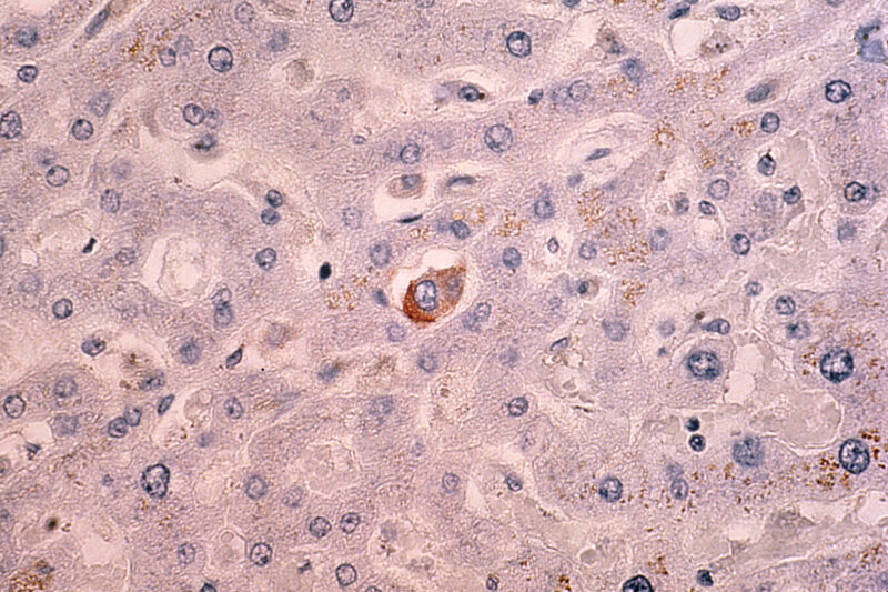 How Cancer Spreads