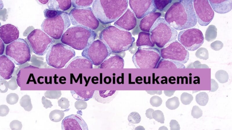 Erdal Toprak: More Effective, Lower-Toxicity Combination Therapies for Acute Myeloid Leukemia