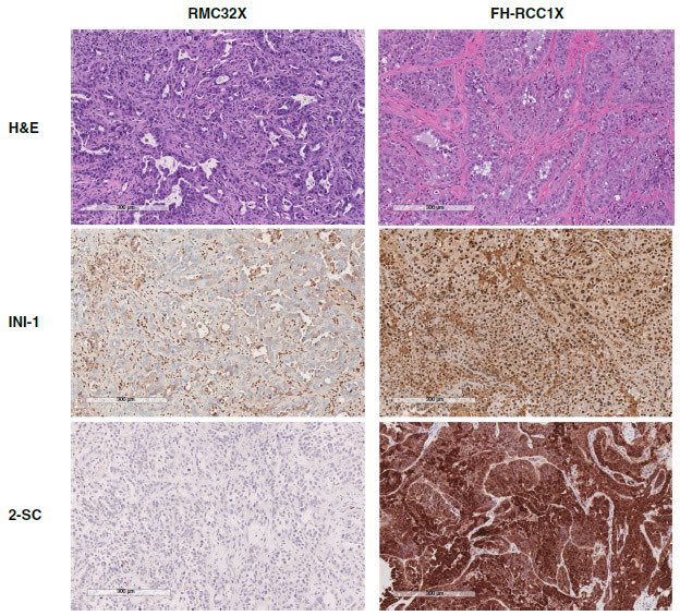 Bevacizumab 