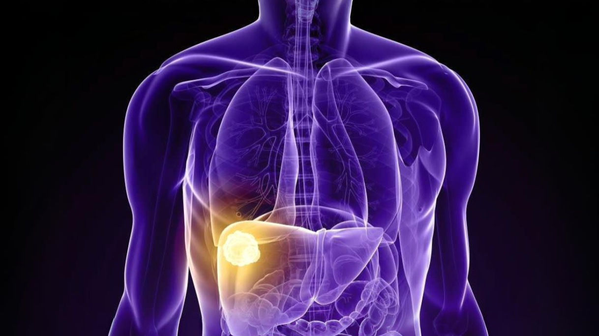 UCLA Study Identifies Key Protein that Helps Liver Cancer Resist Heat-Based Treatment