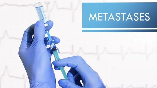 Gene Expression Profiling of Breast Cancer Brain Metastases – Mirrors of Medicine