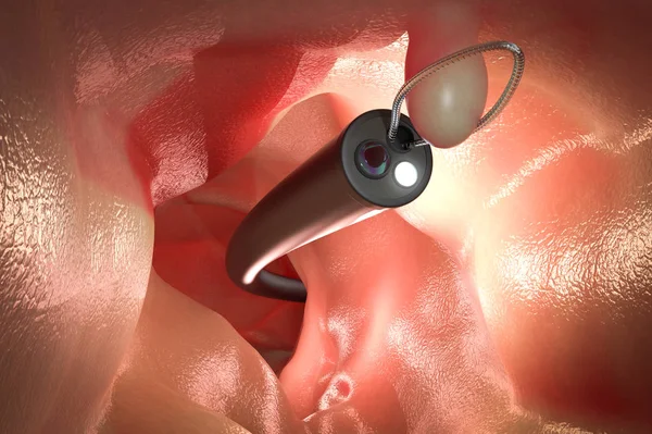 colonoscopy cancer screening