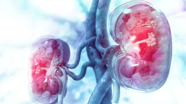 AACR Project GENIE Uncovers Insights into the Pathogenesis of a Rare Kidney Cancer