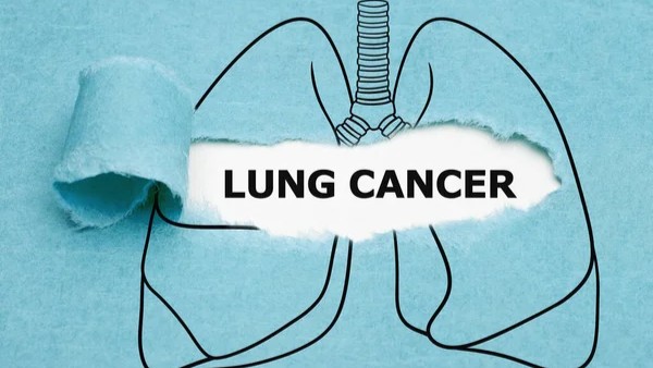 What is MET in Lung Cancer? – Lung Cancer Europe