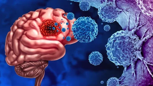 Therapeutic Update: Nimotuzumab and Vinorelbine for Midline Gliomas – AIEOP