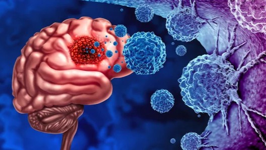 Patrick Soon-Shiong: One of the Most Difficult Tumors to Treat – Glioblastoma