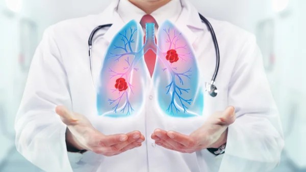 The Launch of Australia’s National Lung Cancer Screening Program – Lung Cancer Policy Network