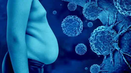 Obesity and Breast Cancer: Can Weight Control Improve Survival? – Yale Cancer Center