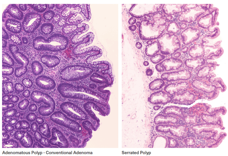 Colonoscopy cancer screening