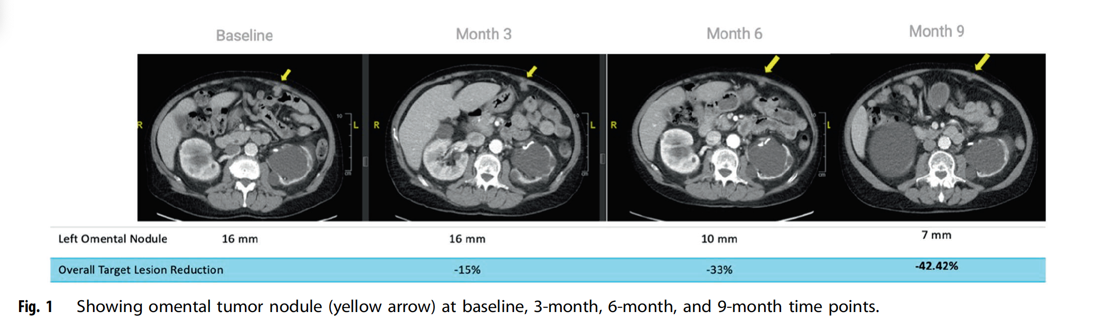 oncogene inkt solid tumors