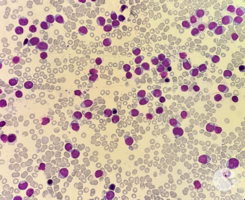 New Series by Nico Gagelmann: Rarity in Hematology - BPDCN