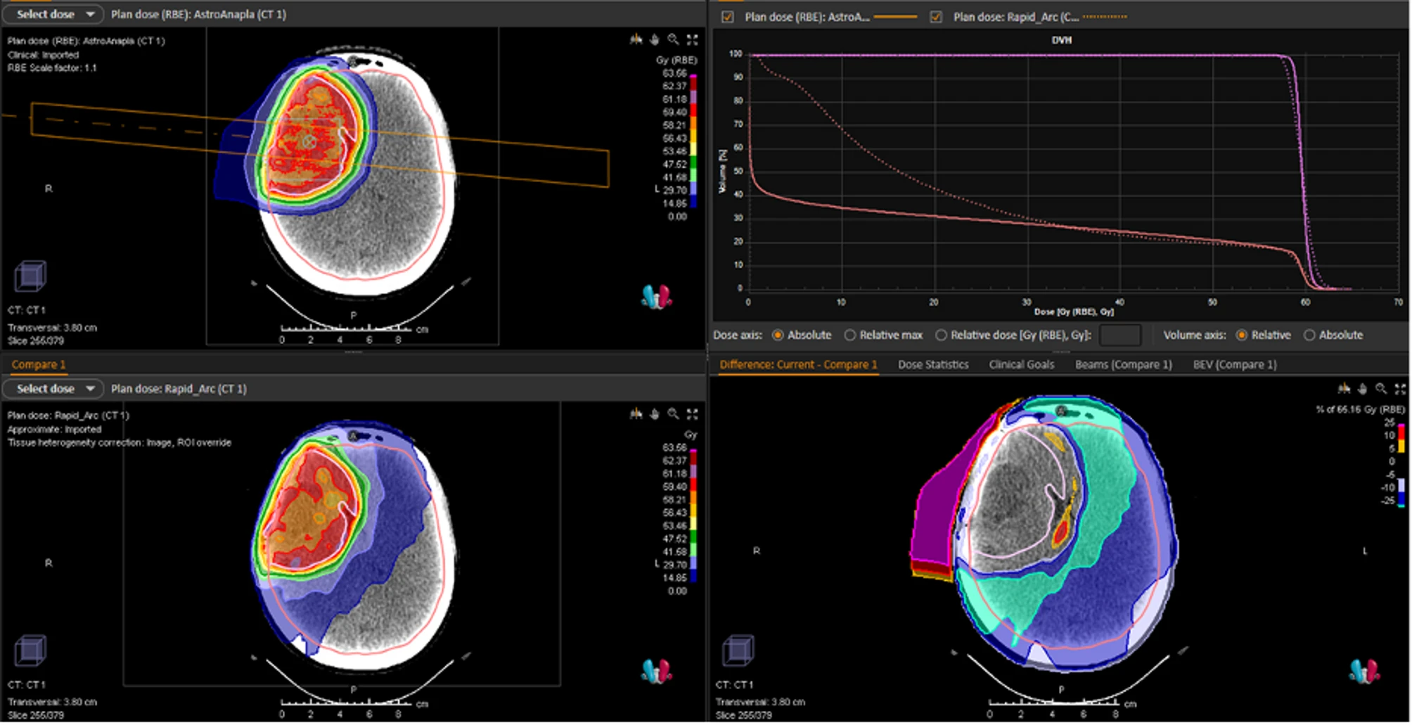IDH-mutant glioma