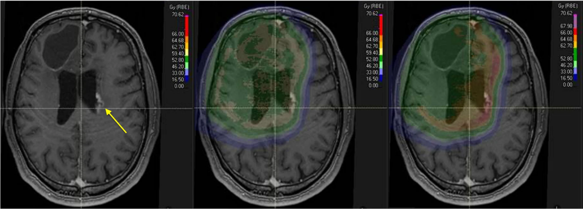 IDH-mutant Glioma
