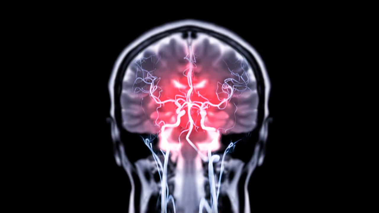 Stanislav Lazarev Highlights Key Insights from Proton vs Photon CSI for Leptomeningeal Disease