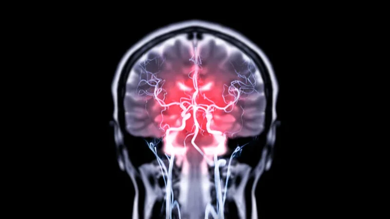 Stanislav Lazarev Highlights Key Insights from Proton vs Photon CSI for Leptomeningeal Disease