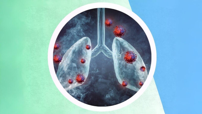 Moffitt Cancer Center Launches an Enhanced Form of TIL Therapy Study for NSCLC – ALK Positive
