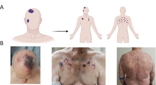 New Series by Nico Gagelmann: Rarity in Hematology - BPDCN