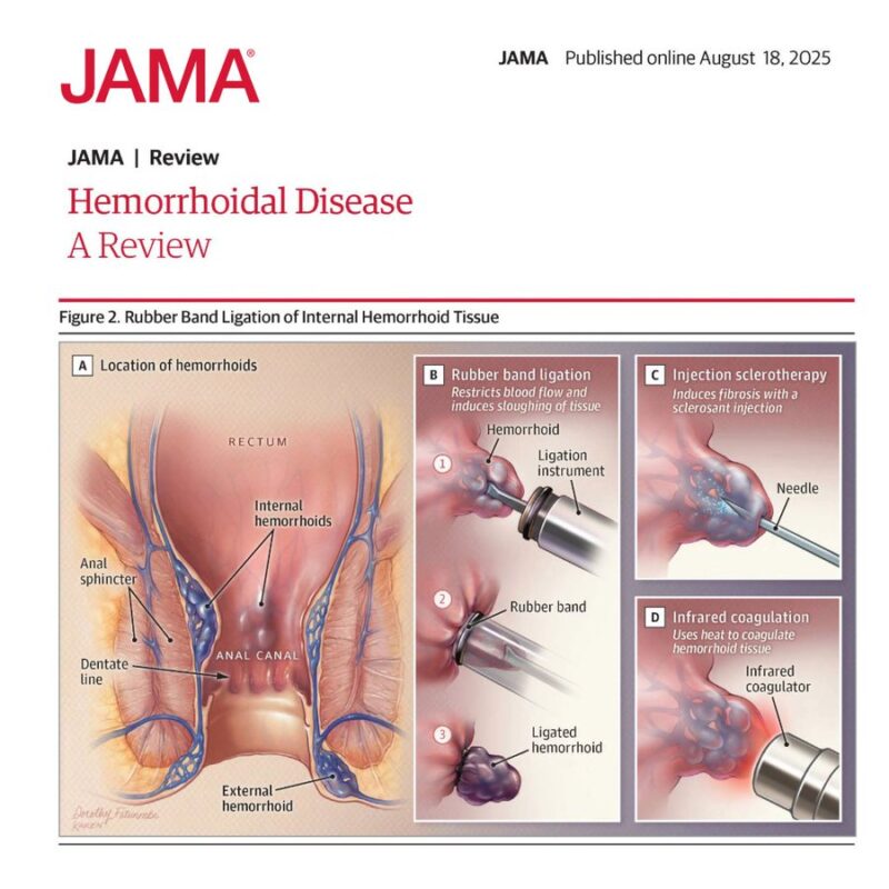 Oscar Tahuahua: Physical Examination as the Most Valuable Step in the Diagnosis of Hemorrhoidal Disease