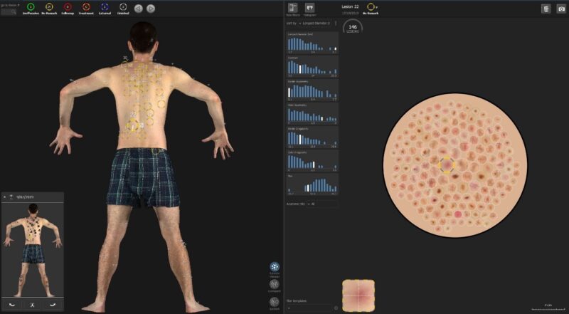 ALM Automated lesion mapping