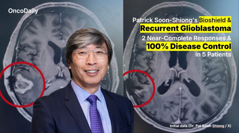 Soon-Shiong’s “Bioshield” Sparks Early Promise in Recurrent GBM, With 2 Near-CRs and 100% Disease Control