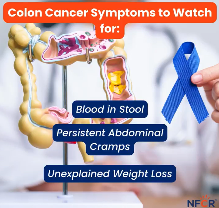 Colon Cancer