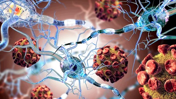 A Turning Point in H3 K27M-mutant Diffuse Midline Glioma – Jazz Pharmaceuticals