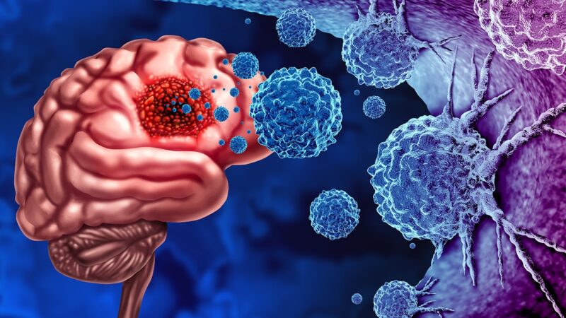 New Treatment Option for H3 K27M-Mutant Glioma Treatment – Jazz Pharmaceuticals