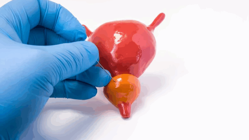 Miguel Bronchud: Underestimation of Risk by Biopsies Alone Could Lead to Undertreatment in Prostate Cancer