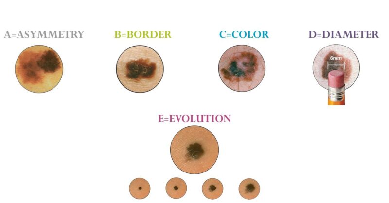 Total Body Photography and Automated Lesion Mapping: The Next Stage in Skin Cancer Surveillance