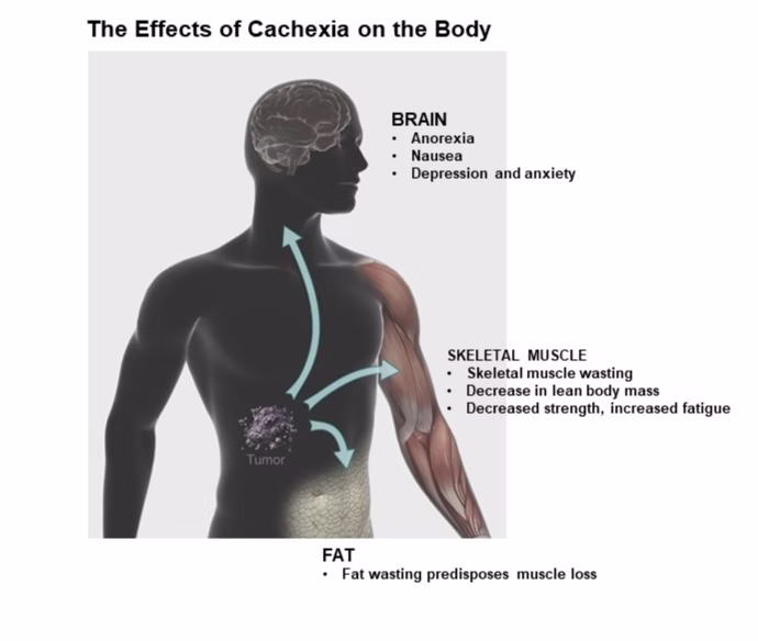 World Cancer Cachexia Day 2025 - effects