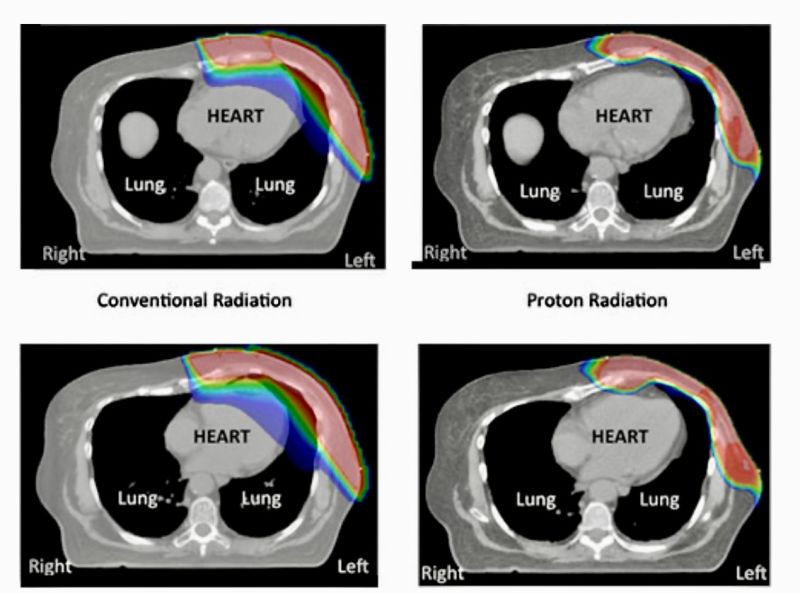 Kefah Mokbel: Proton vs Photon Therapy in Breast Cancer