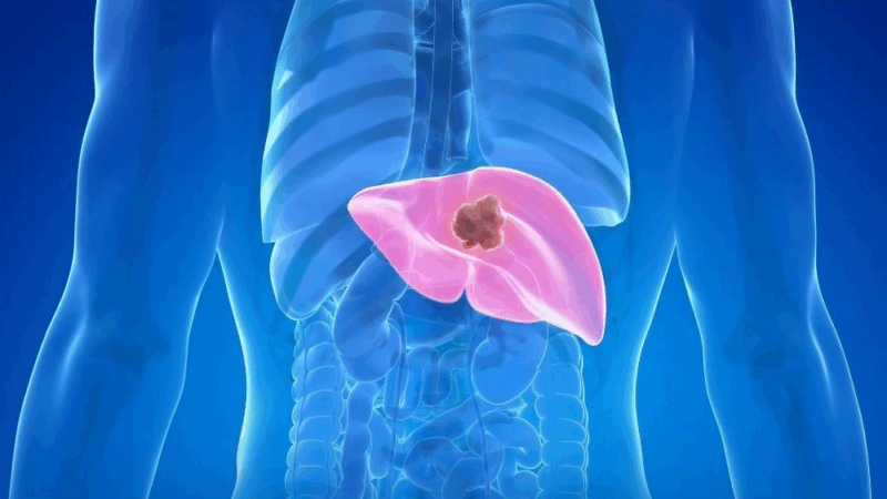 Results of the Joint EORTC-JCOG DREAM Trial Are Published in JAMA Surgery