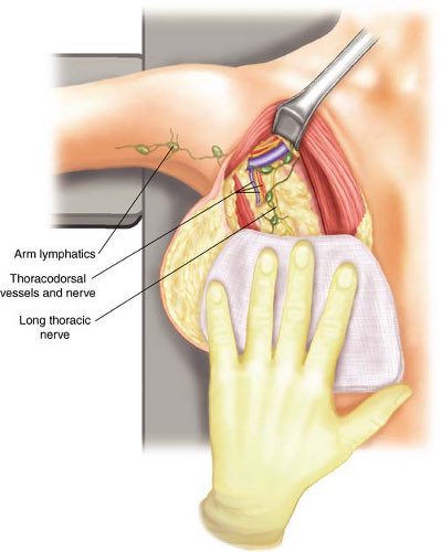 Shahrin Ahmed: Axillary Dissection Following Breast Cancer Treatment