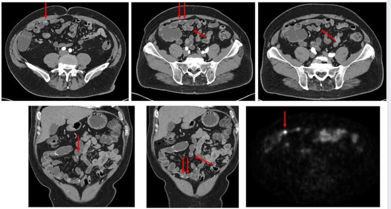 Thor Halfdanarson: The Impact of Imaging Quality on the Assessment of Localized Small Ileal NETs