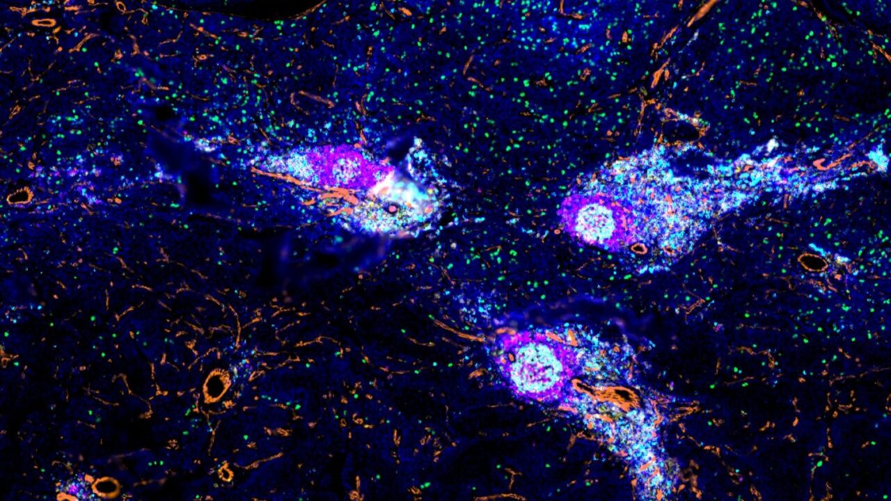 Advancing Neuroblastoma Research Through Immune Cell Mapping – The Institute of Cancer Research