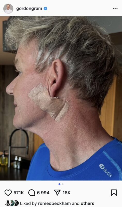 Gordon Ramsay skin cancer