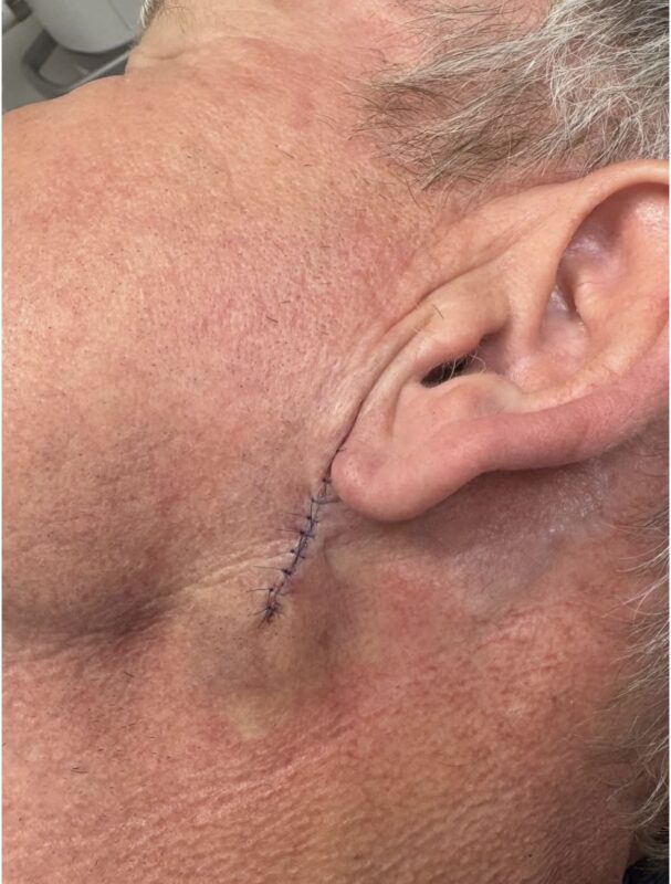 Gordon Ramsay skin cancer