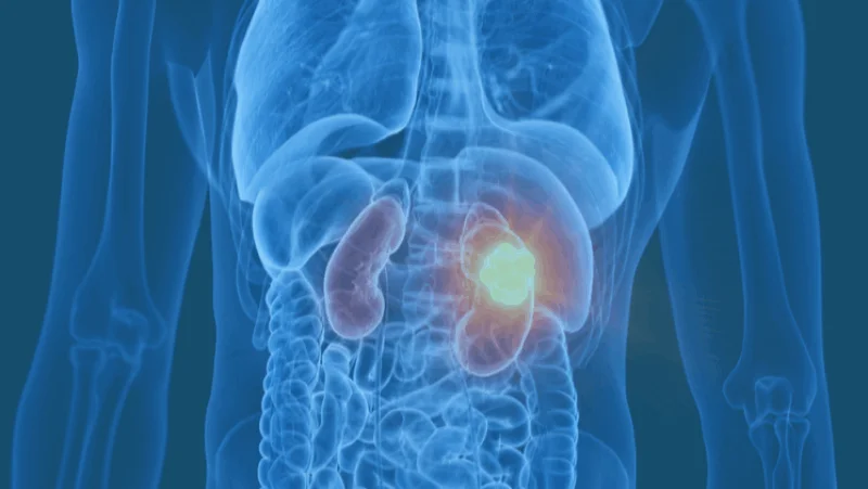 Advances in Renal Cancer Therapeutics and Research Symposium – NCCS