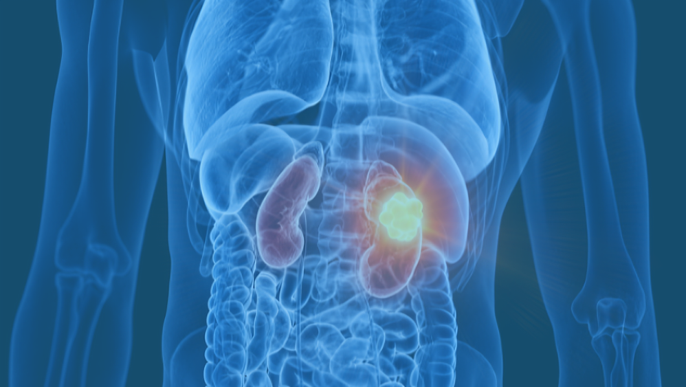 Renal Cancer