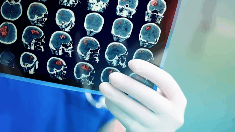 Pavlina Lenga: Challenging the Benign Paradigm of Adult Pilocytic Astrocytomas