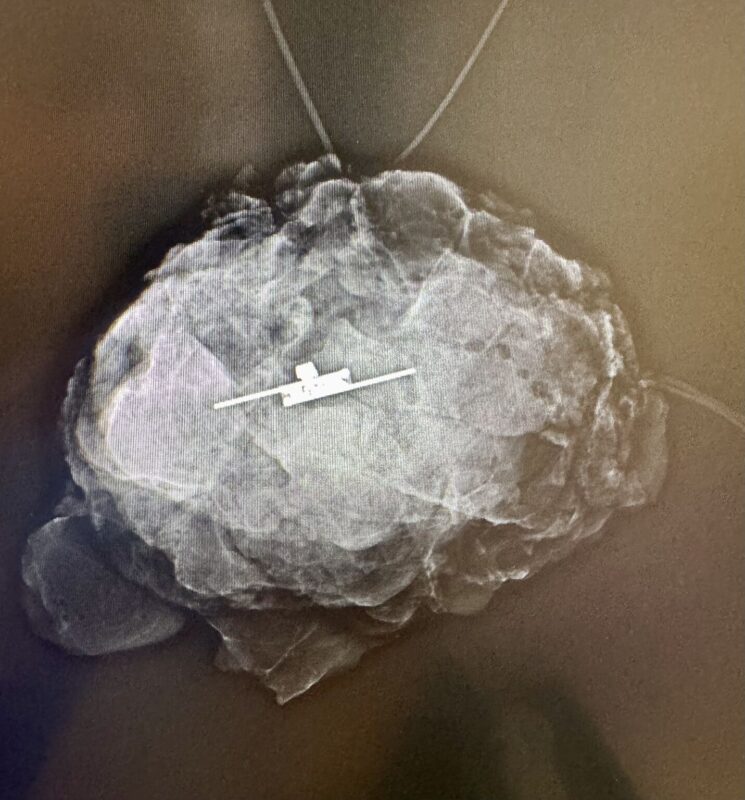 Kefah Mokbel: The Remarkable Progress in Breast Localisation and Excision Techniques