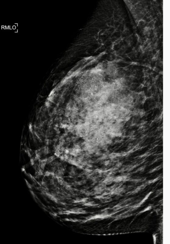 Kefah Mokbel: Rethinking Surgery for DCIS 2 Kefah Mokbel