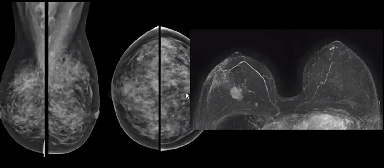 Breast MRI