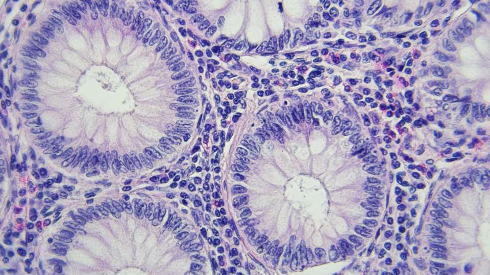 Targeted Therapy